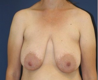Breast Lift 311 - before - front
