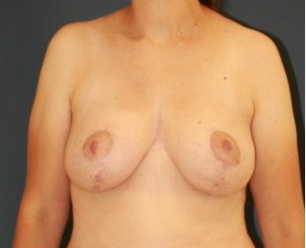 Breast Lift 311 - after - front