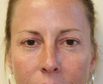 Blepharoplasty Case 28 - before - front