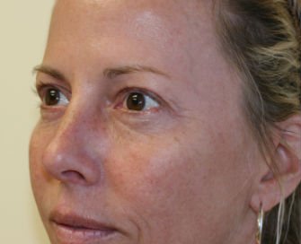 Blepharoplasty Case 28 - before - left oblique