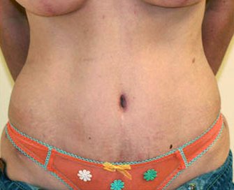 Tummy Tuck Case 10 - after - front