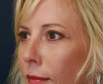 Blepharoplasty Case 28 - after - left oblique