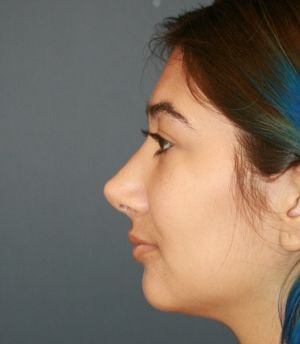 Rhinoplasty 218 - after - oblique