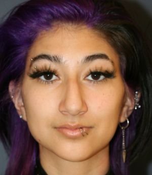 Rhinoplasty 218 - before - right side