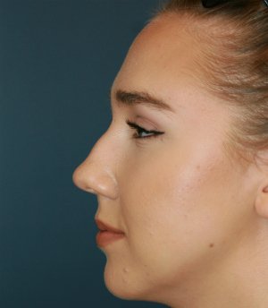 Rhinoplasty 219 - before - front