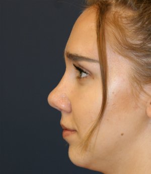 Rhinoplasty 219 - after - front