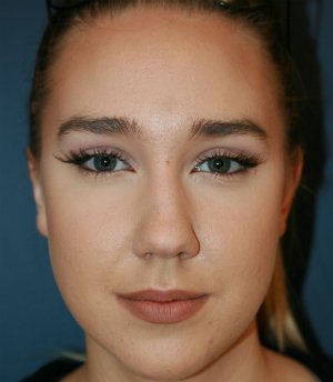 Rhinoplasty 219 - before - oblique