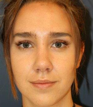 Rhinoplasty 219 - after - oblique