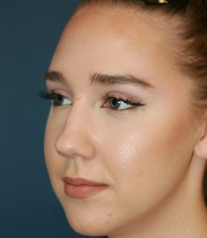 Rhinoplasty 219 - before - side