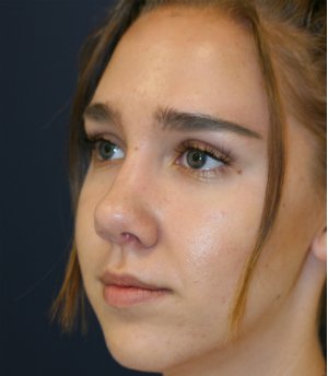 Rhinoplasty 219 - after - side