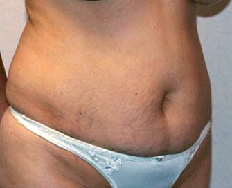 Tummy Tuck Case 10 - before - angle