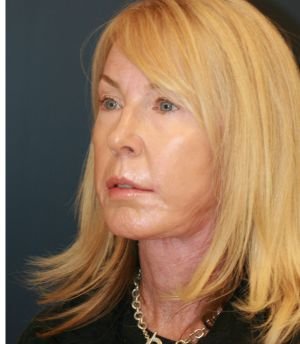 Face-Lift-San-Diego-82 - after - oblique