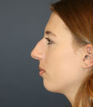Nose Surgery San Diego 184 - before - front