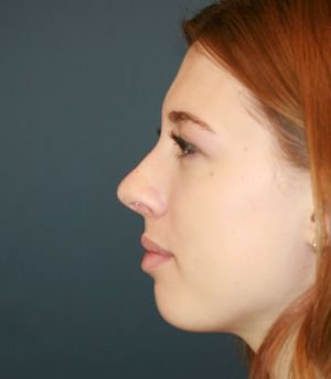 Nose Surgery San Diego 184 - after - front