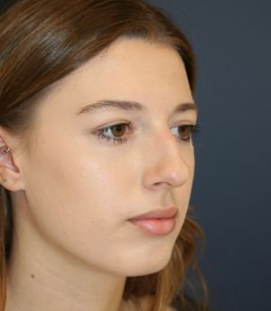 Nose Surgery San Diego 184 - before - oblique