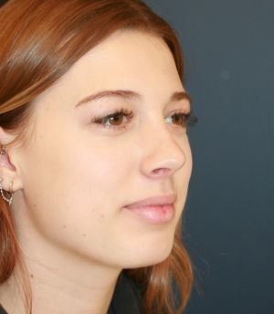 Nose Surgery San Diego 184 - after - oblique