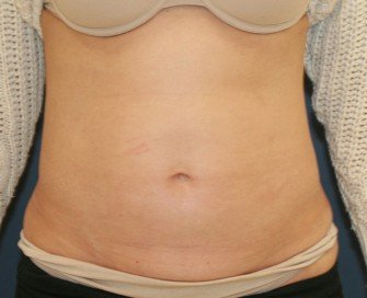 TummyTuck LA - before - front