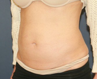 TummyTuck LA - before - oblique