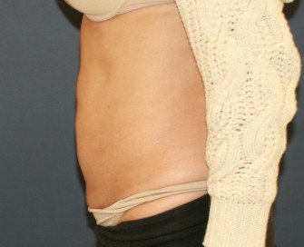 TummyTuck LA - before - side