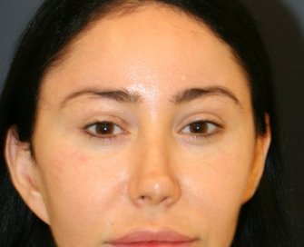 Bratz Blepharoplasty - before - front