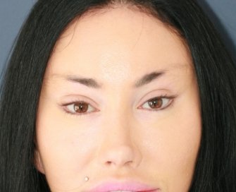 Bratz Blepharoplasty - after - front