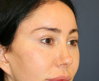 Bratz Blepharoplasty - before - right oblique
