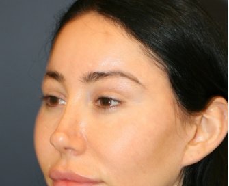 Bratz Blepharoplasty - before - left oblique