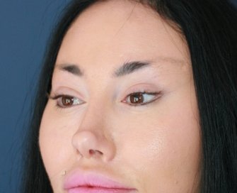 Bratz Blepharoplasty - after - left oblique
