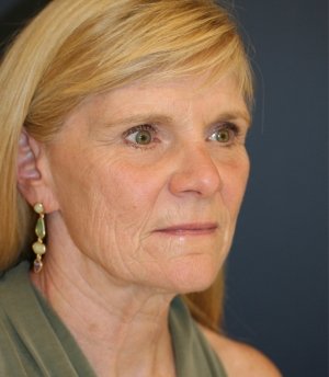 Facelift Natural - before - oblique