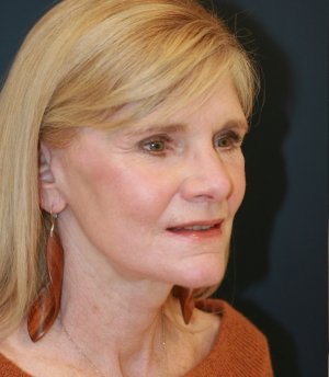 Facelift Natural - after - oblique