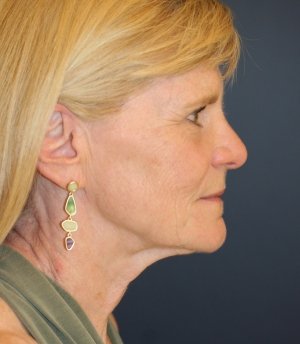 Facelift Natural - before - side