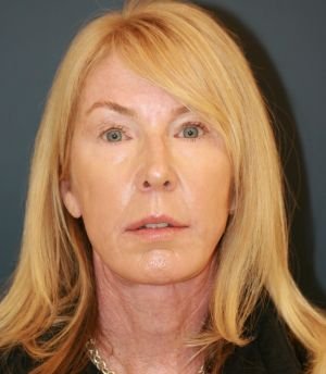 Laser Face Lift - after - front
