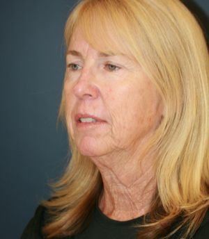 Laser Face Lift - before - oblique