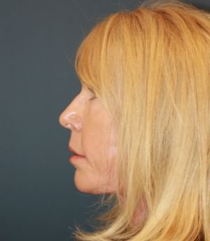 Laser Face Lift - after - side