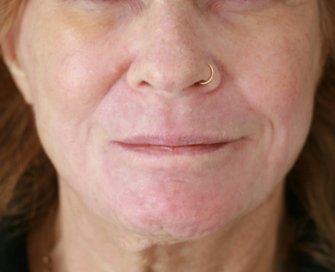 Lip Wrinkles Smoothing - after - front