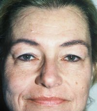 Browlift  Case 8 - before - front
