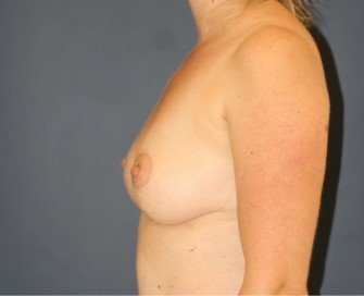 Explant, Lift, Fat Transfer - after - side