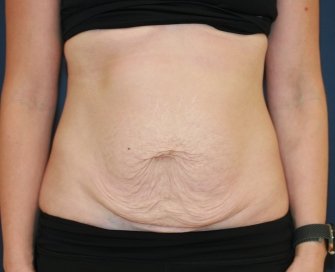 Texas Tummy Tuck - before - front