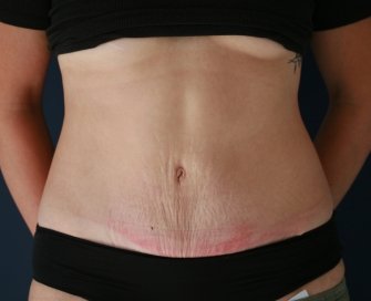 Texas Tummy Tuck - after - front