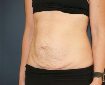 Texas Tummy Tuck - before - oblique
