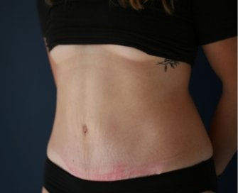 Texas Tummy Tuck - after - oblique