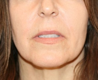 Corner and Lip Lift - before - front