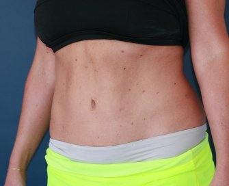 Best Tummy Tuck 38 - after - oblique