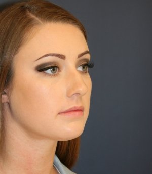 Rhinoplasty 220 - before - oblique
