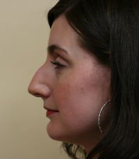 Rhinoplasty Case 18 - before - left