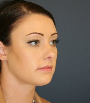 Rhinoplasty 220 - after - oblique