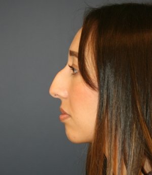 Rhinoplasty 222 - before - front