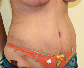 Tummy Tuck Case 10 - after - angle