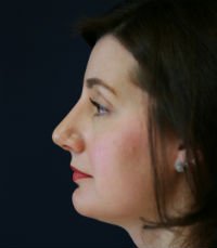 Rhinoplasty Case 18 - after - left