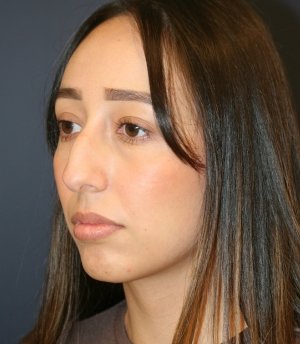Rhinoplasty 222 - before - oblique